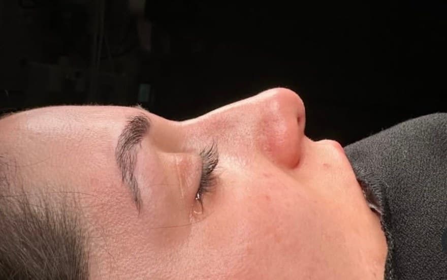 Rhinoplasty — Profile Harmony — after