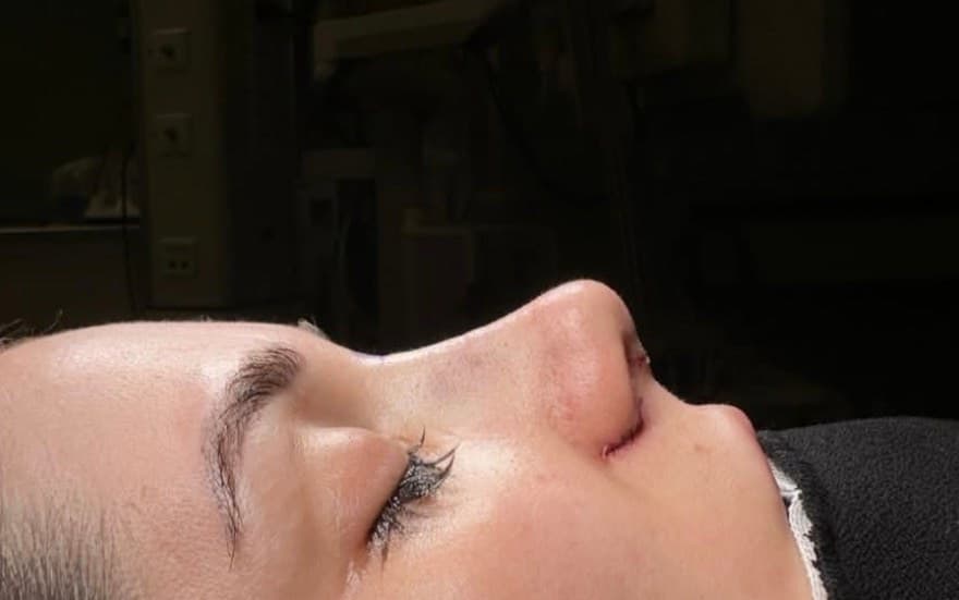 Rhinoplasty — Profile Harmony — before